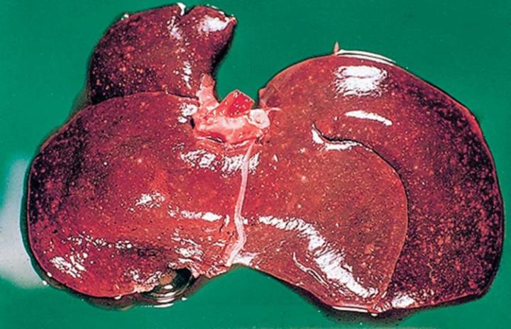 Infected liver